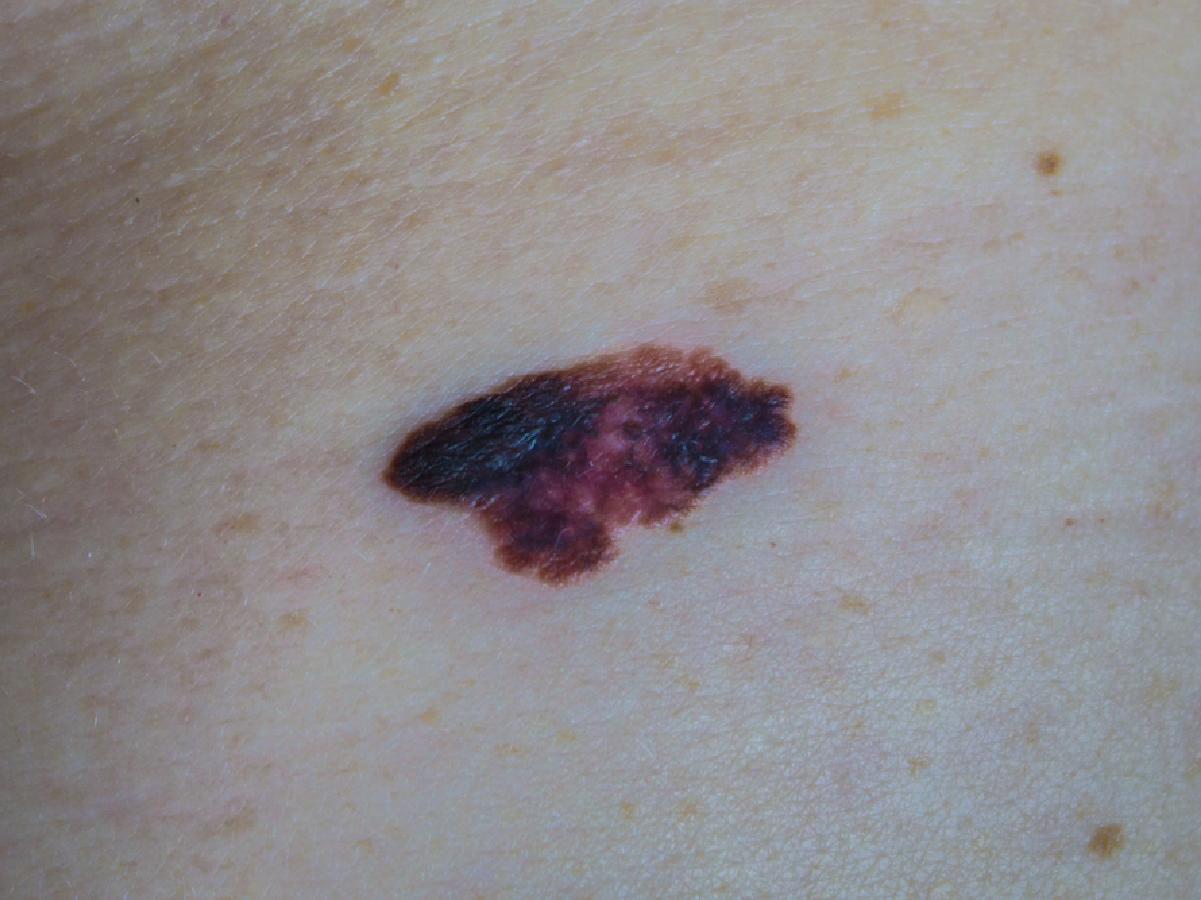 melanoma