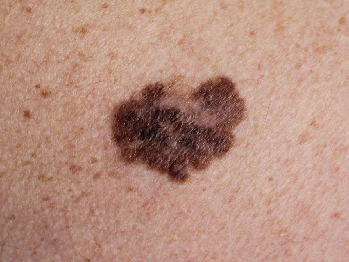 melanoma